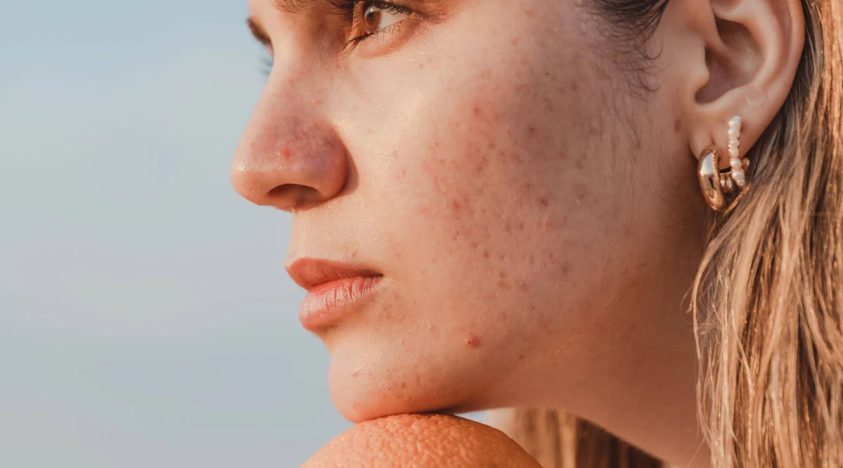 Clear Skin, Clear Confidence: Top 10 Acne-Fighting Tips!